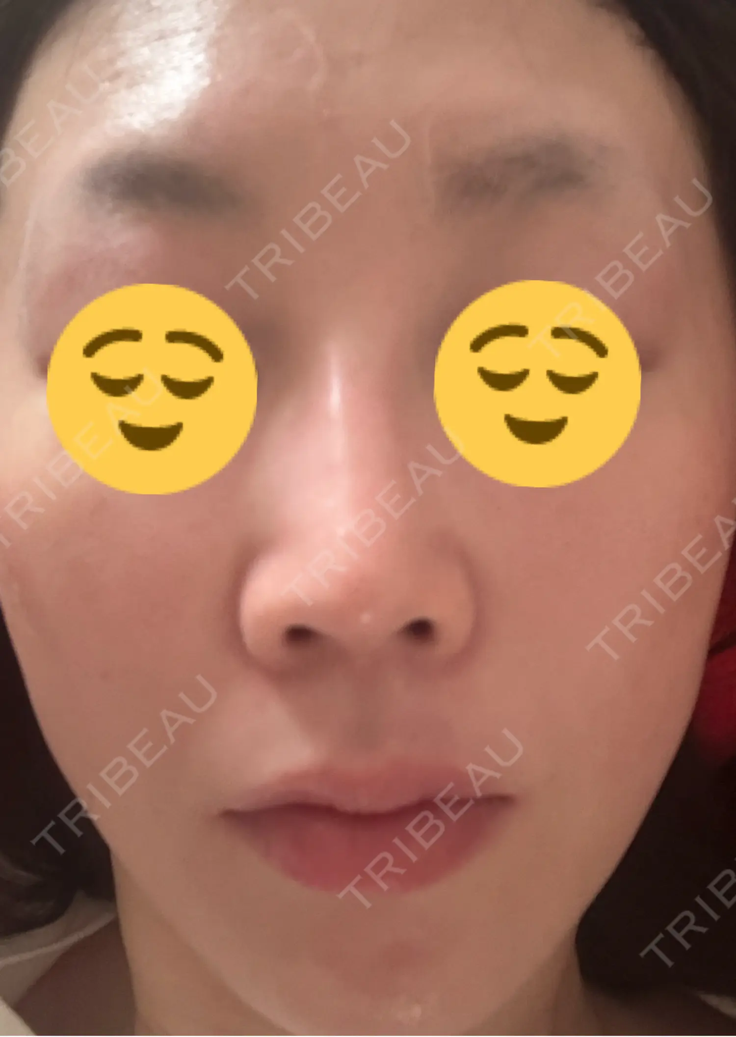 施術後の写真