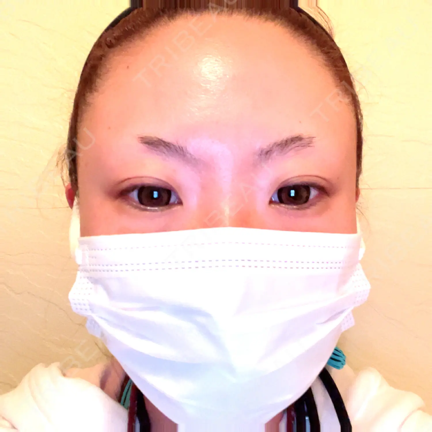 施術後の写真