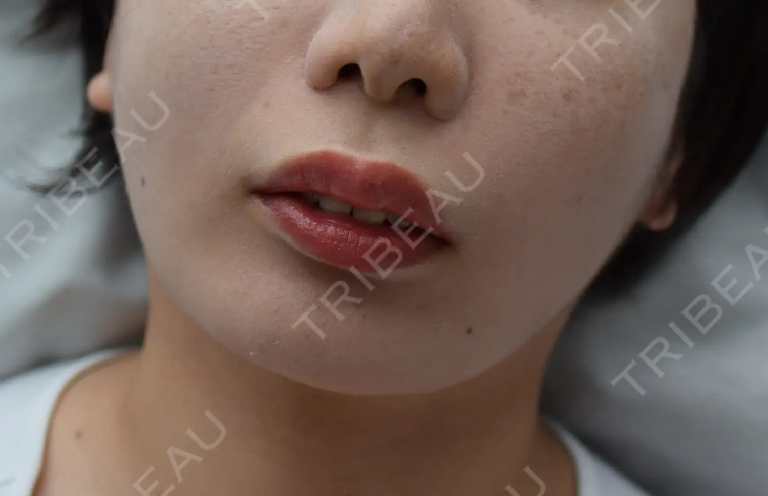 施術後の写真
