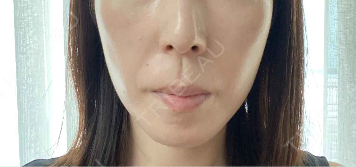 施術後の写真
