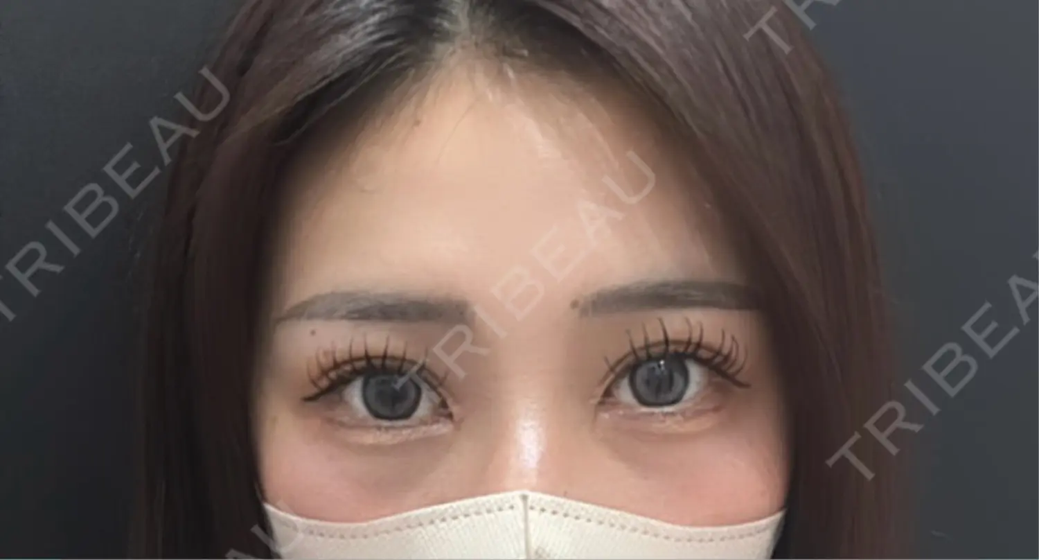 施術後の写真