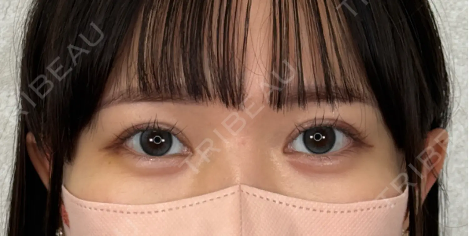 施術後の写真
