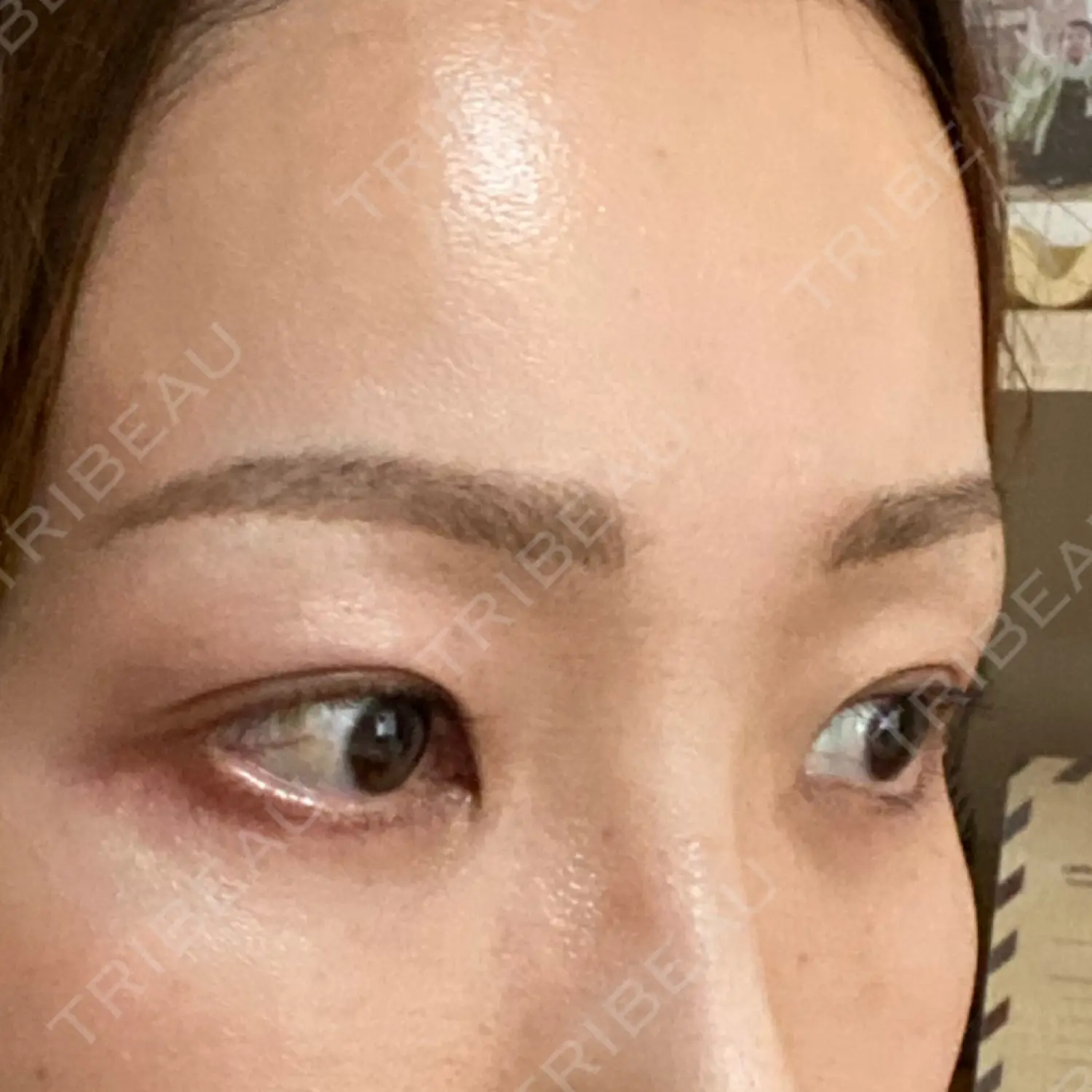施術後の写真