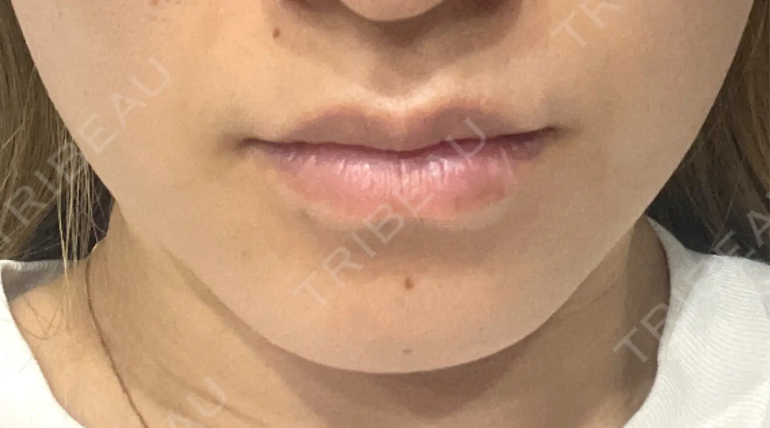施術後の写真