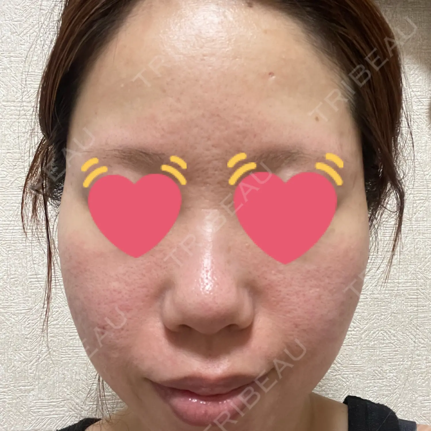 施術後の写真