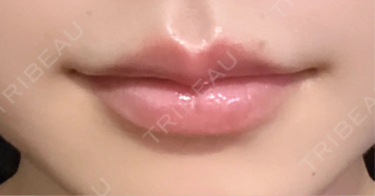 施術後の写真