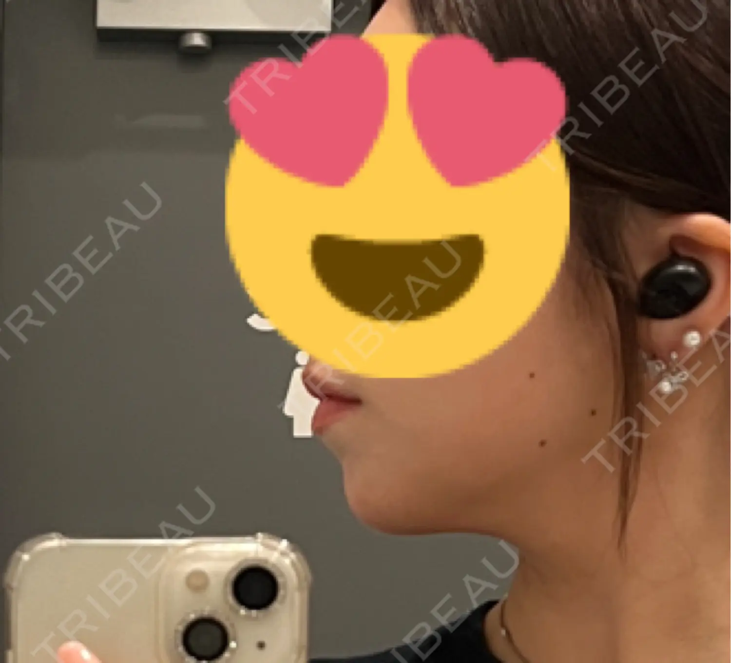施術後の写真