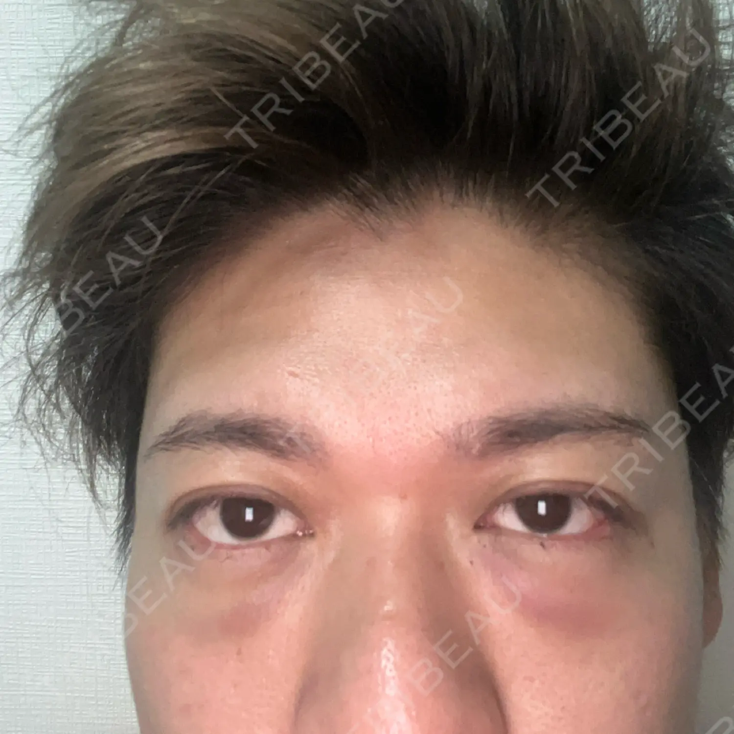 施術後の写真