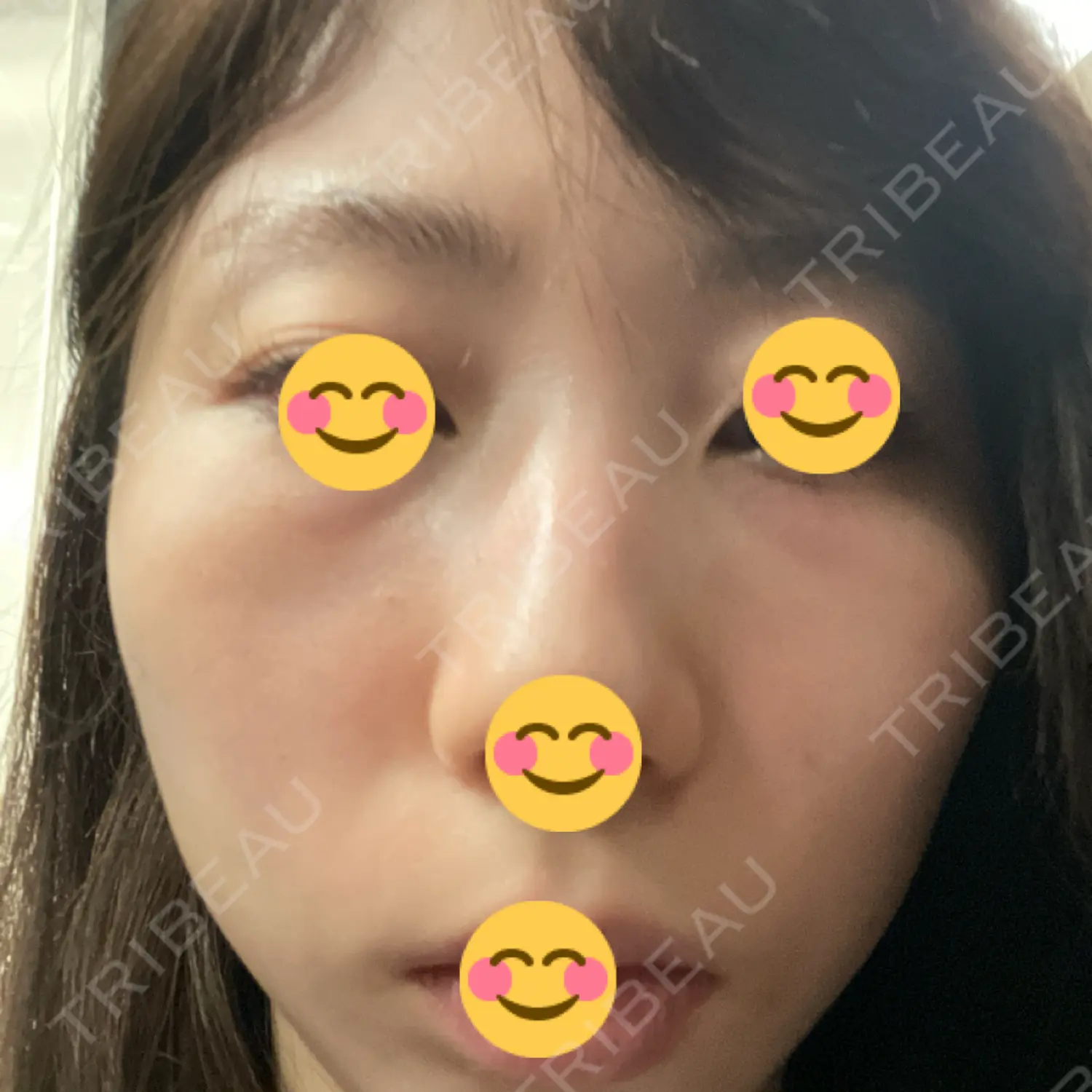 施術後の写真