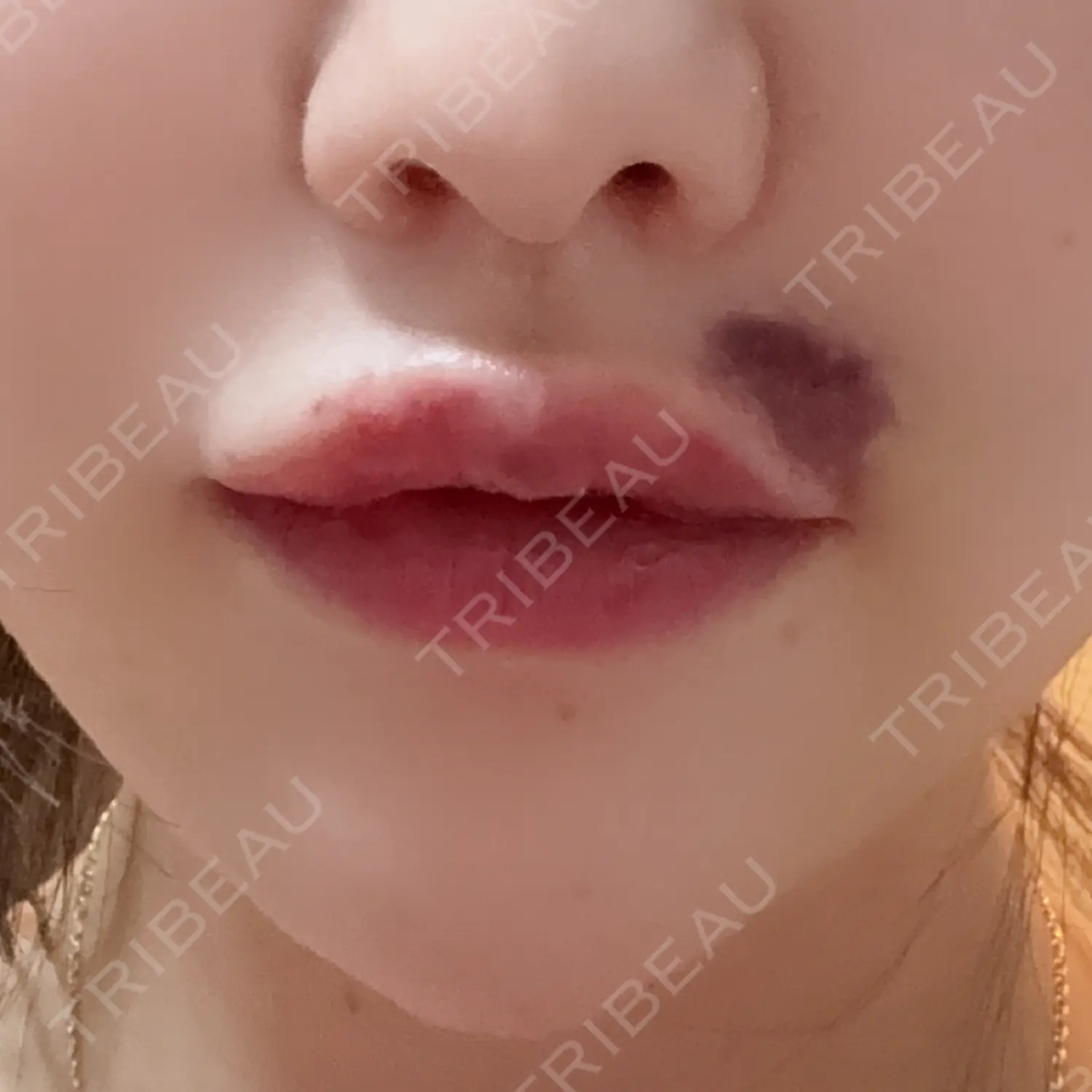施術後の写真