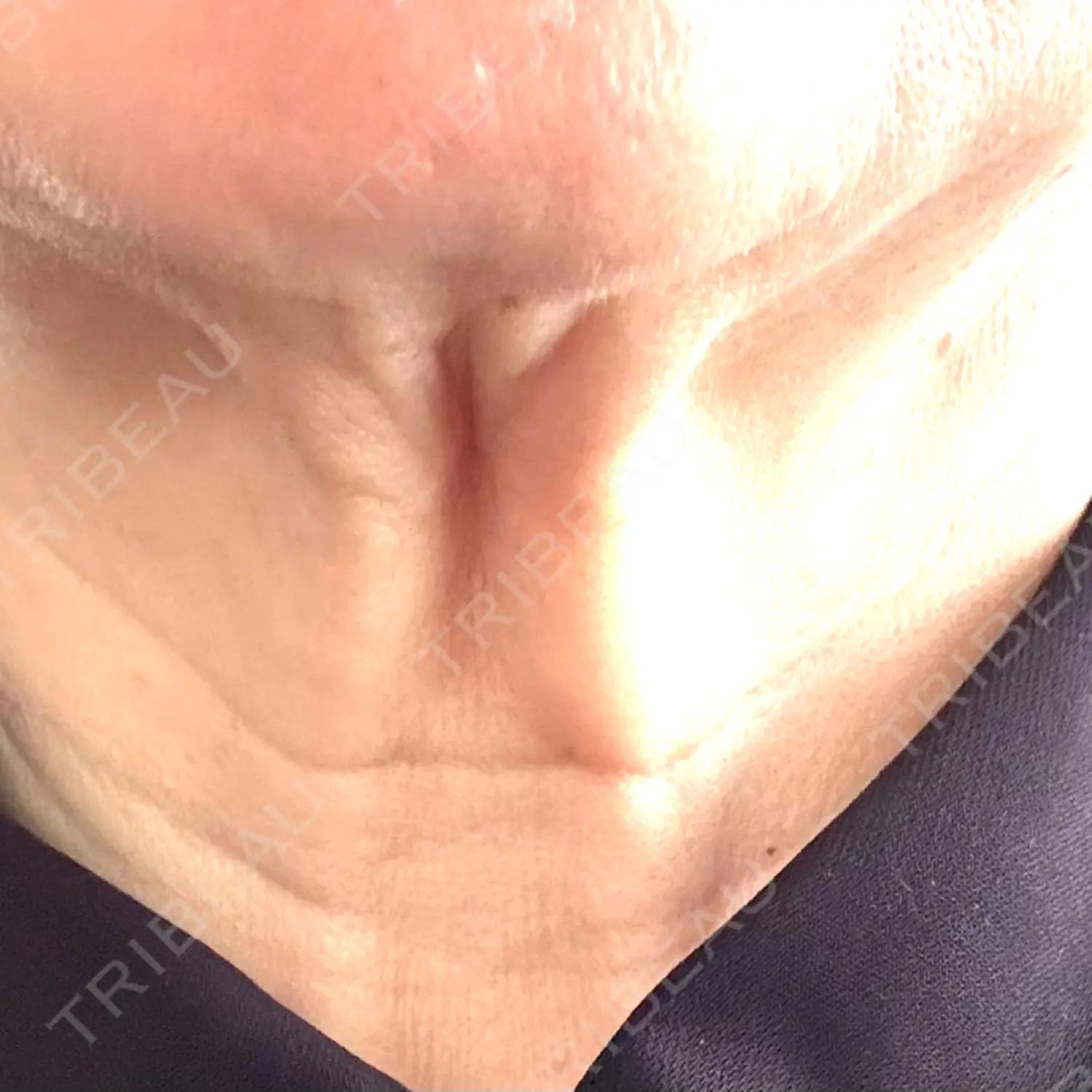 施術後の写真