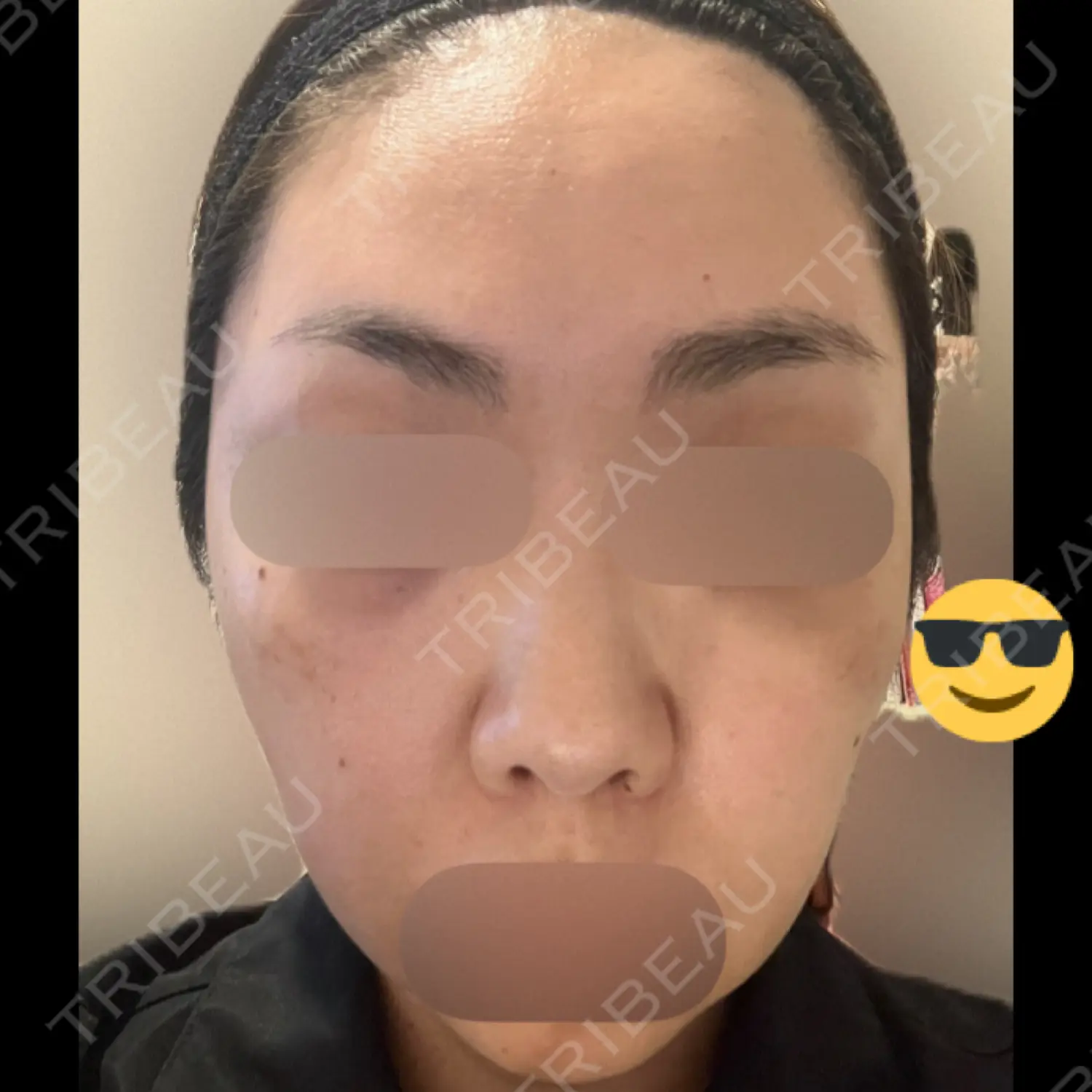 施術後の写真