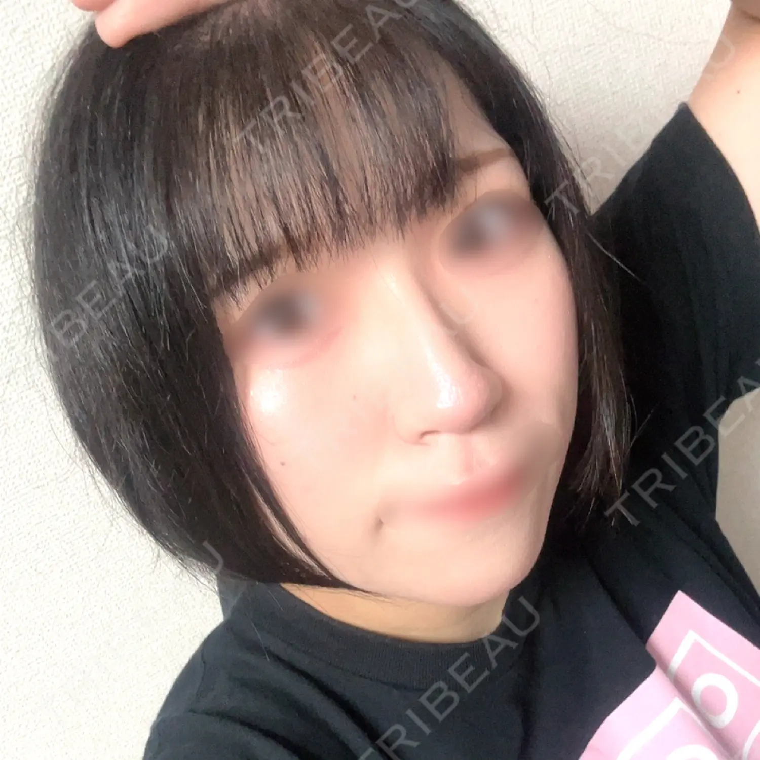 施術後の写真