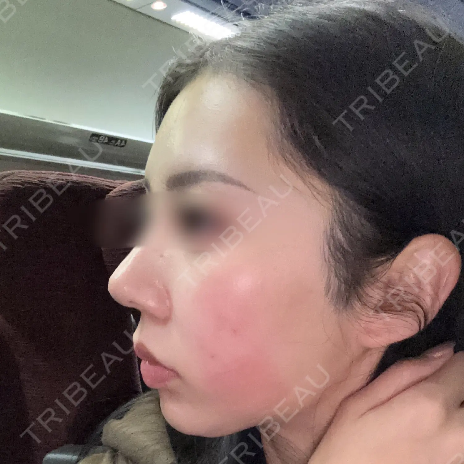 施術後の写真