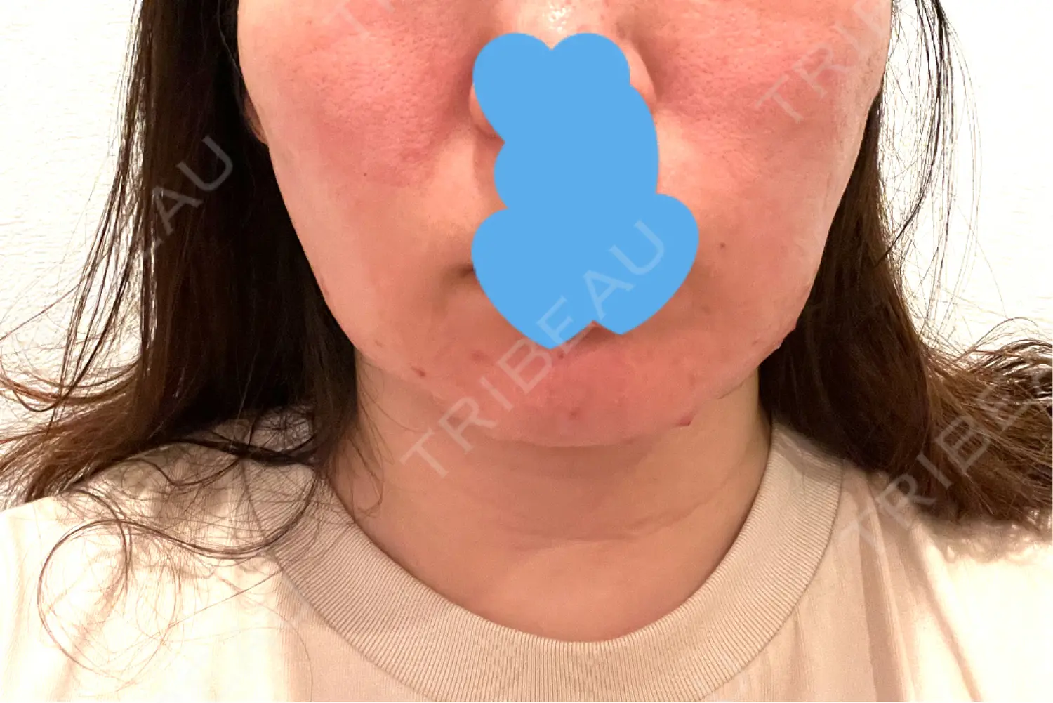 施術後の写真
