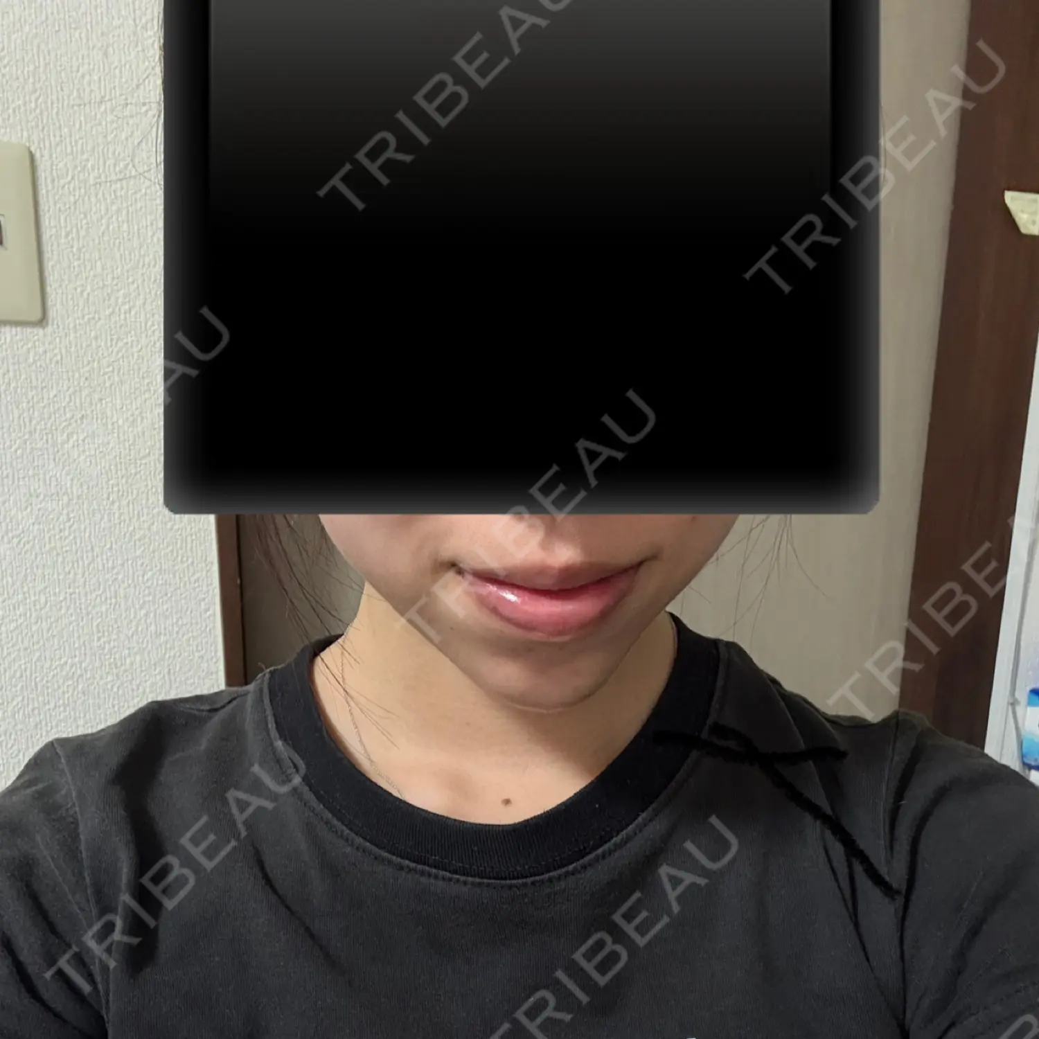 施術後の写真