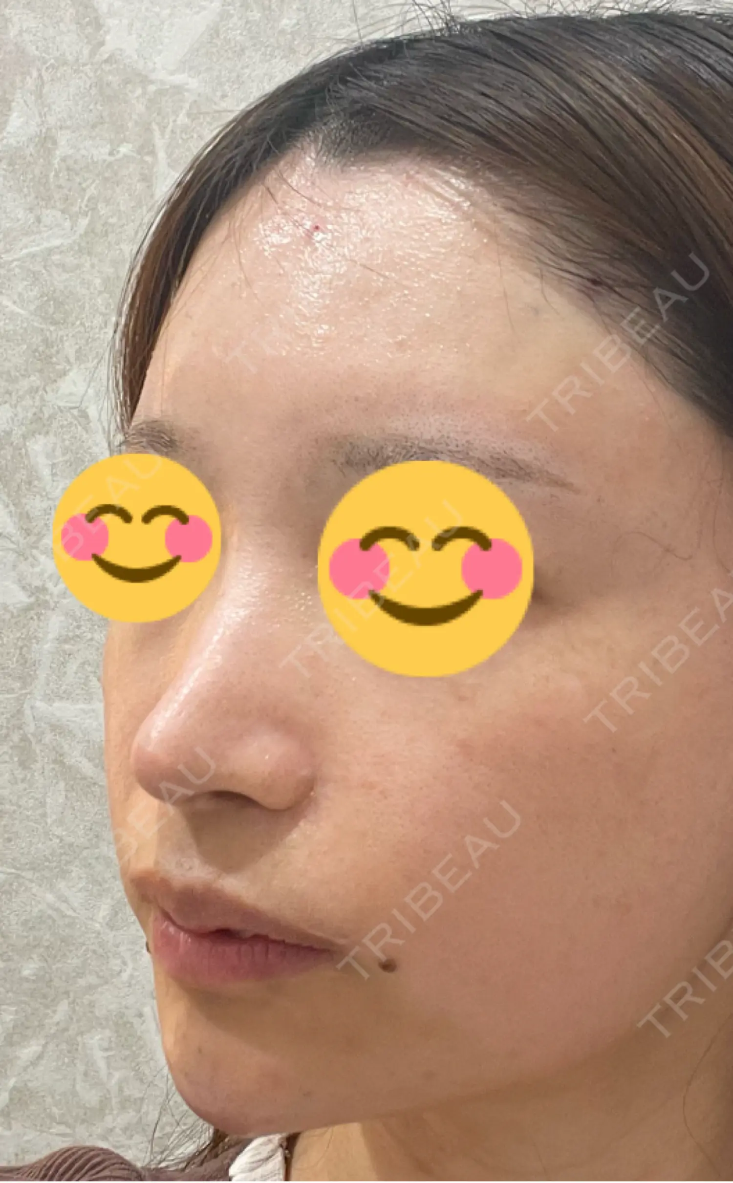 施術後の写真
