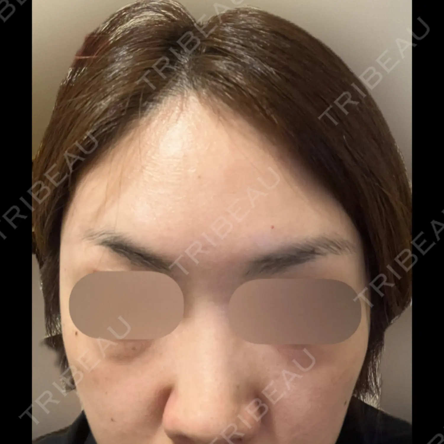 施術後の写真