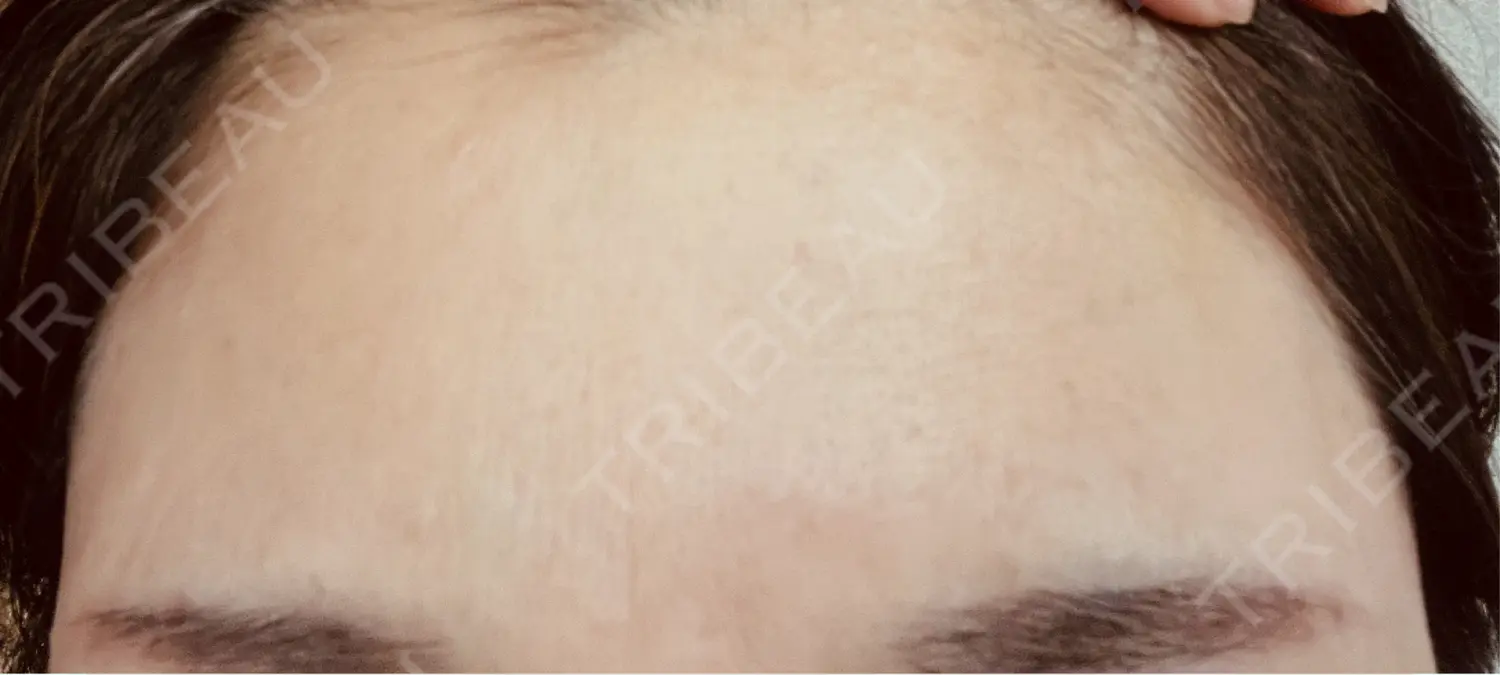 施術後の写真