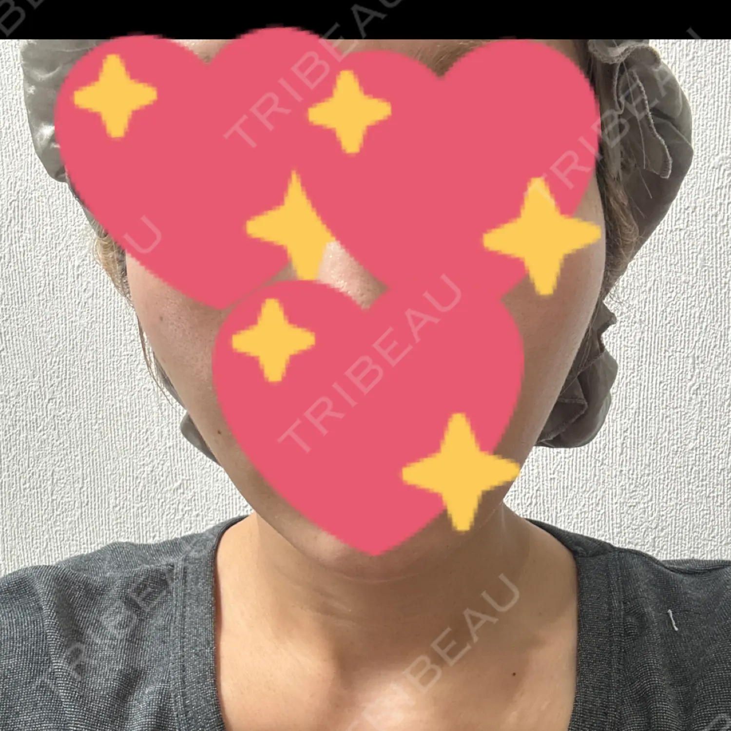 施術後の写真