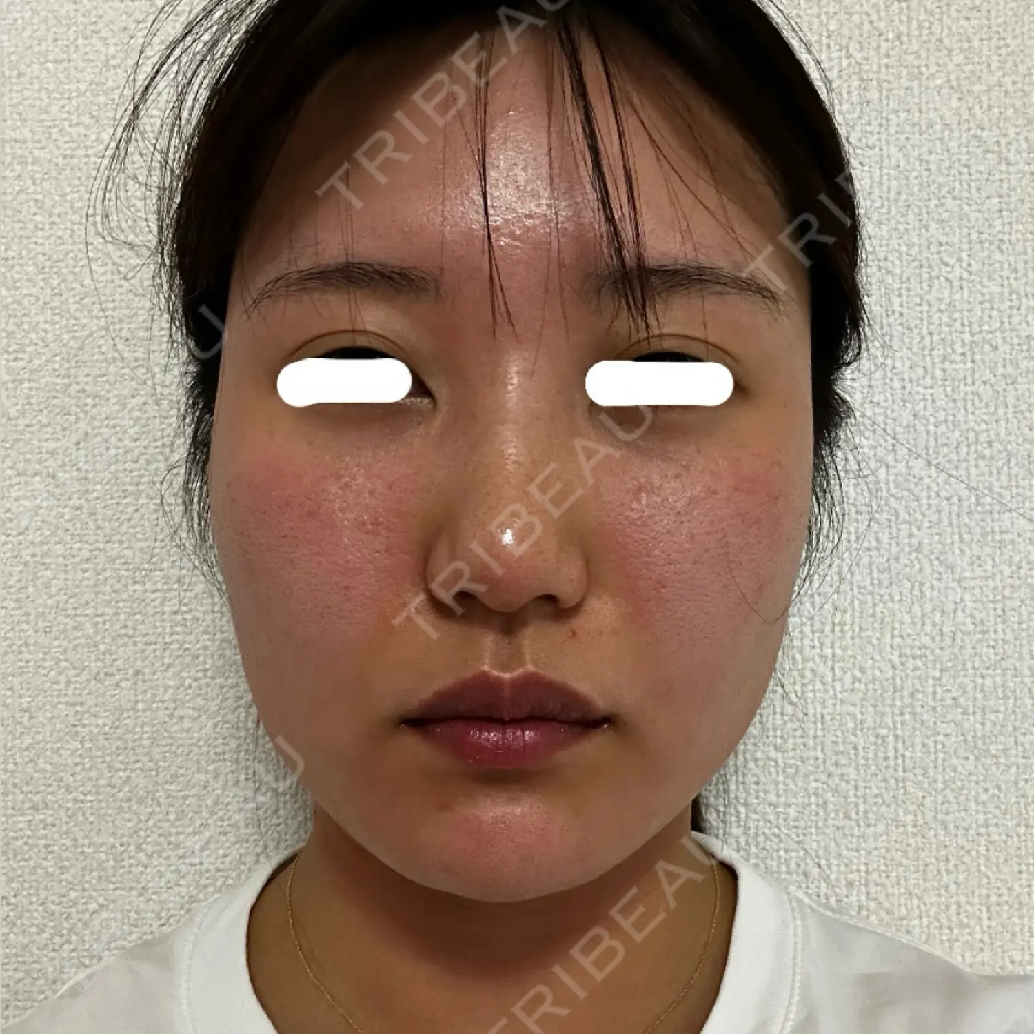 施術後の写真