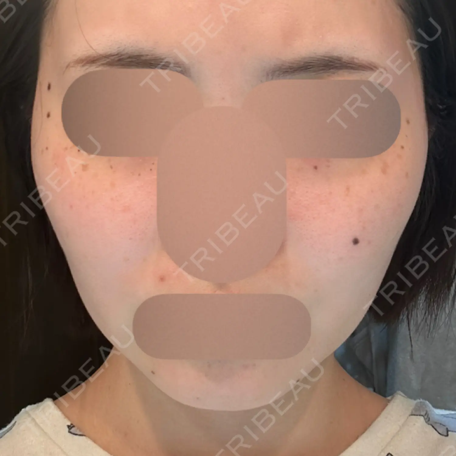 施術後の写真