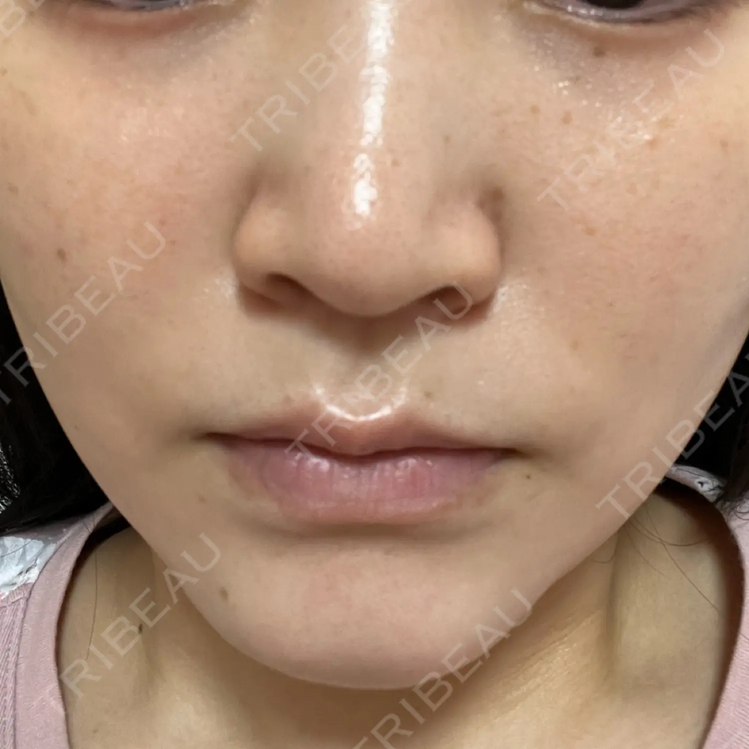 施術後の写真