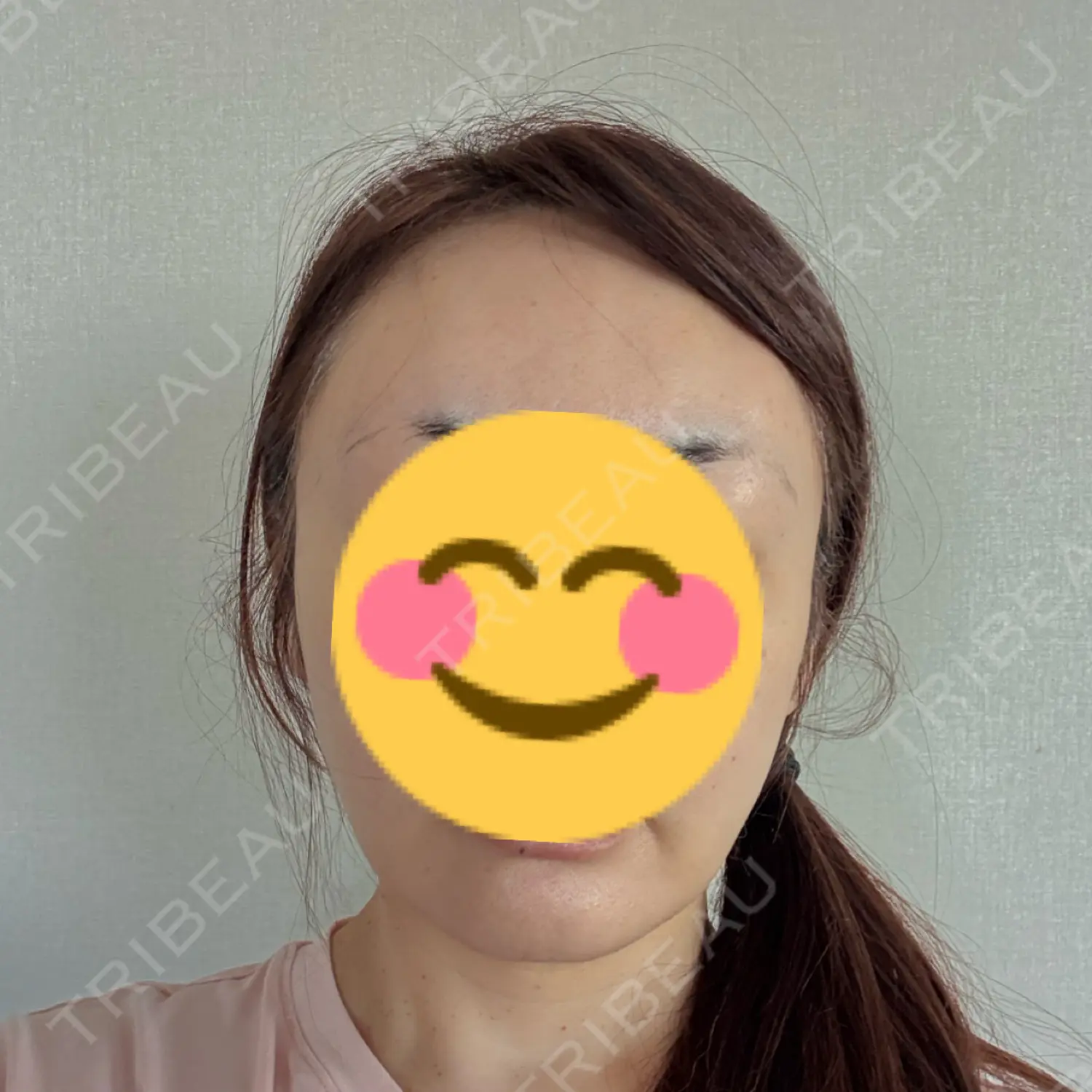 施術後の写真