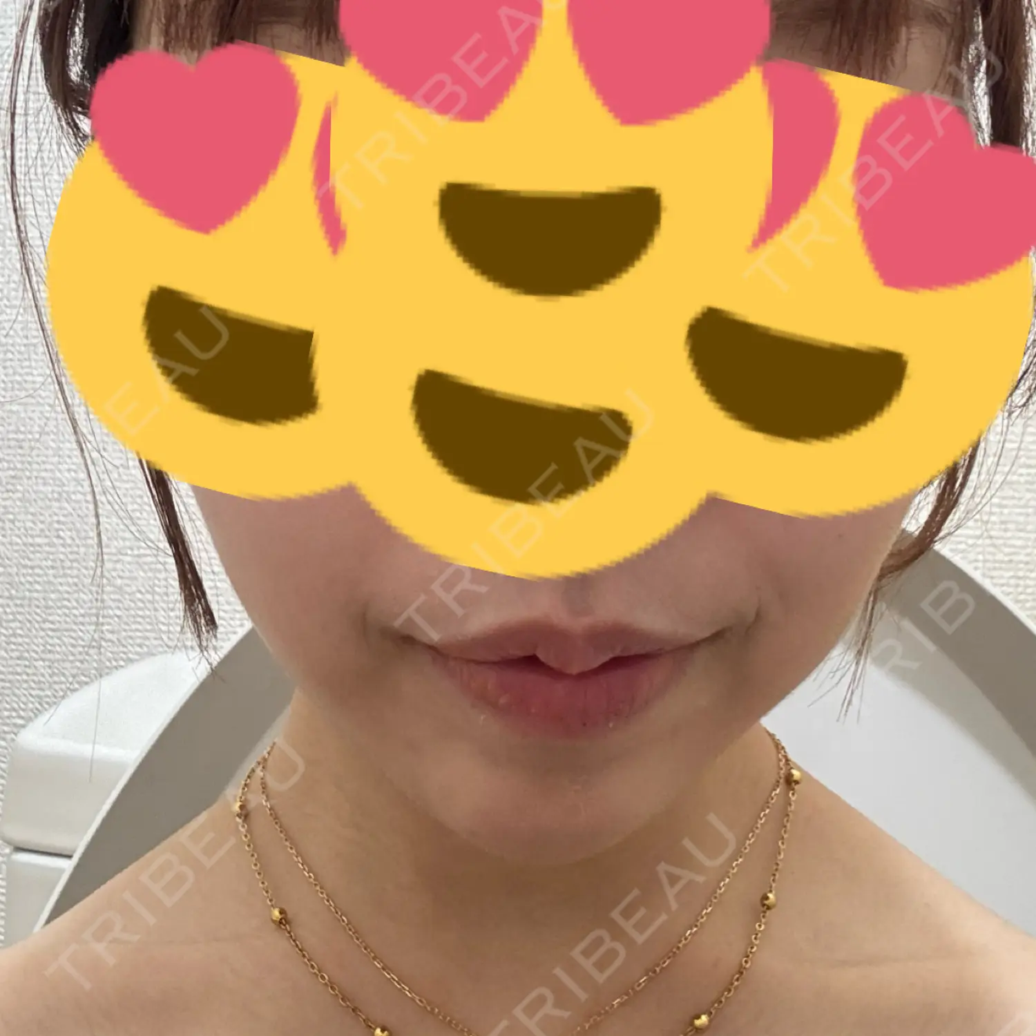 施術後の写真