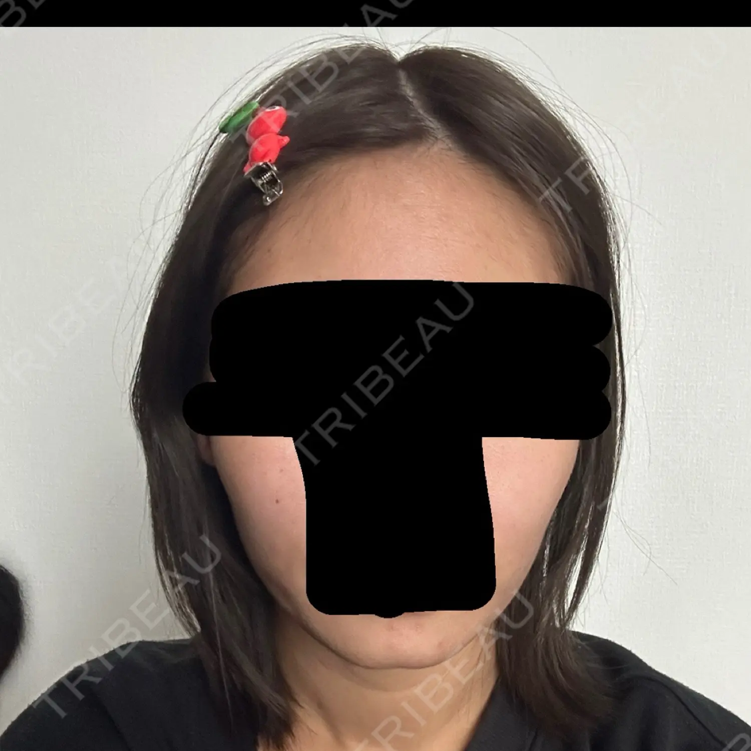 施術後の写真