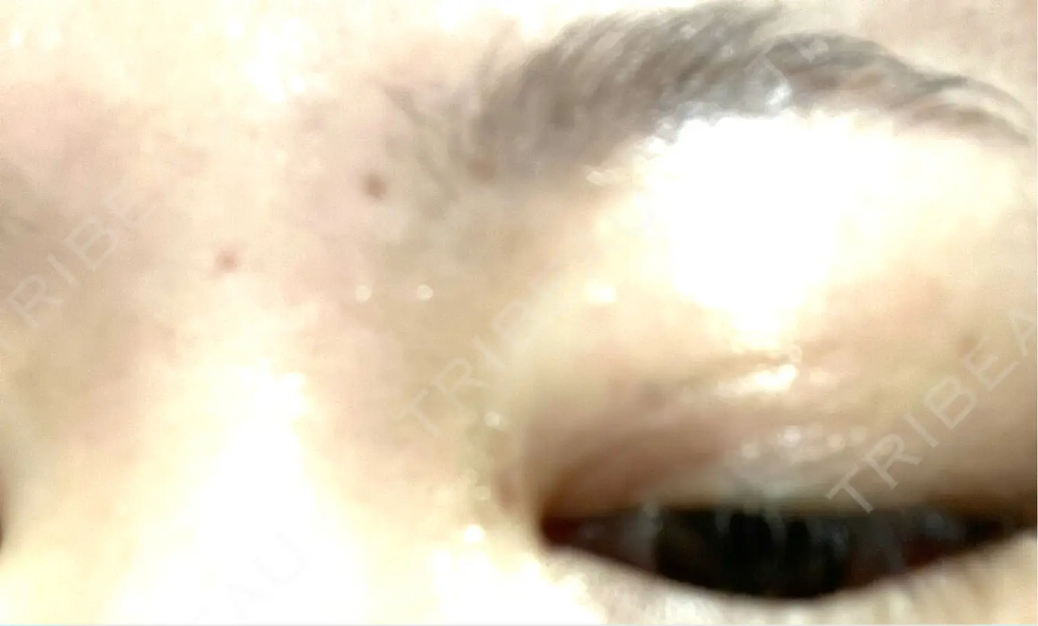 施術後の写真