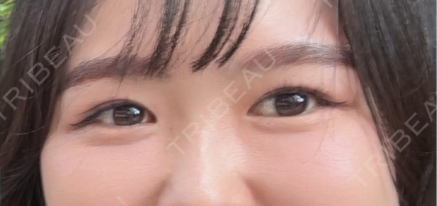 施術後の写真