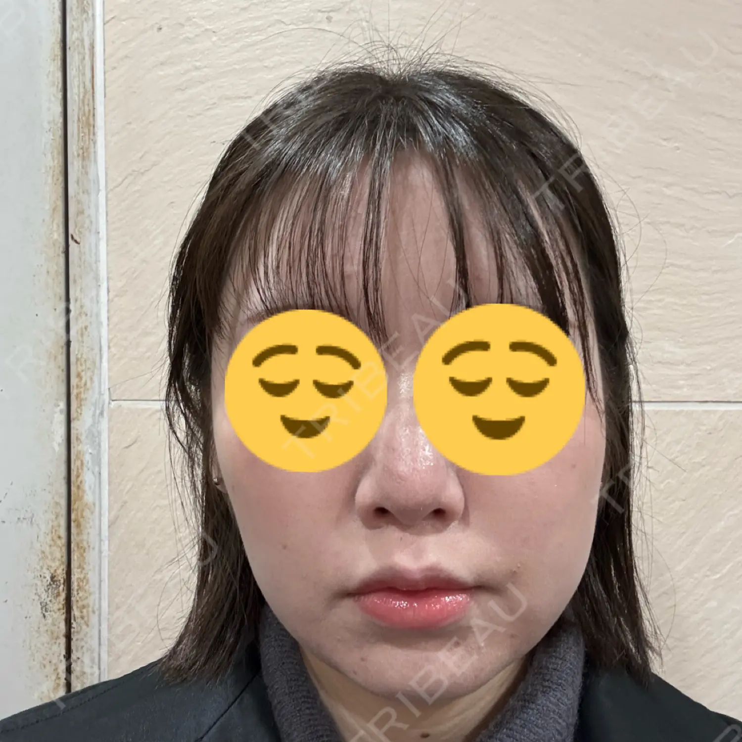 施術後の写真