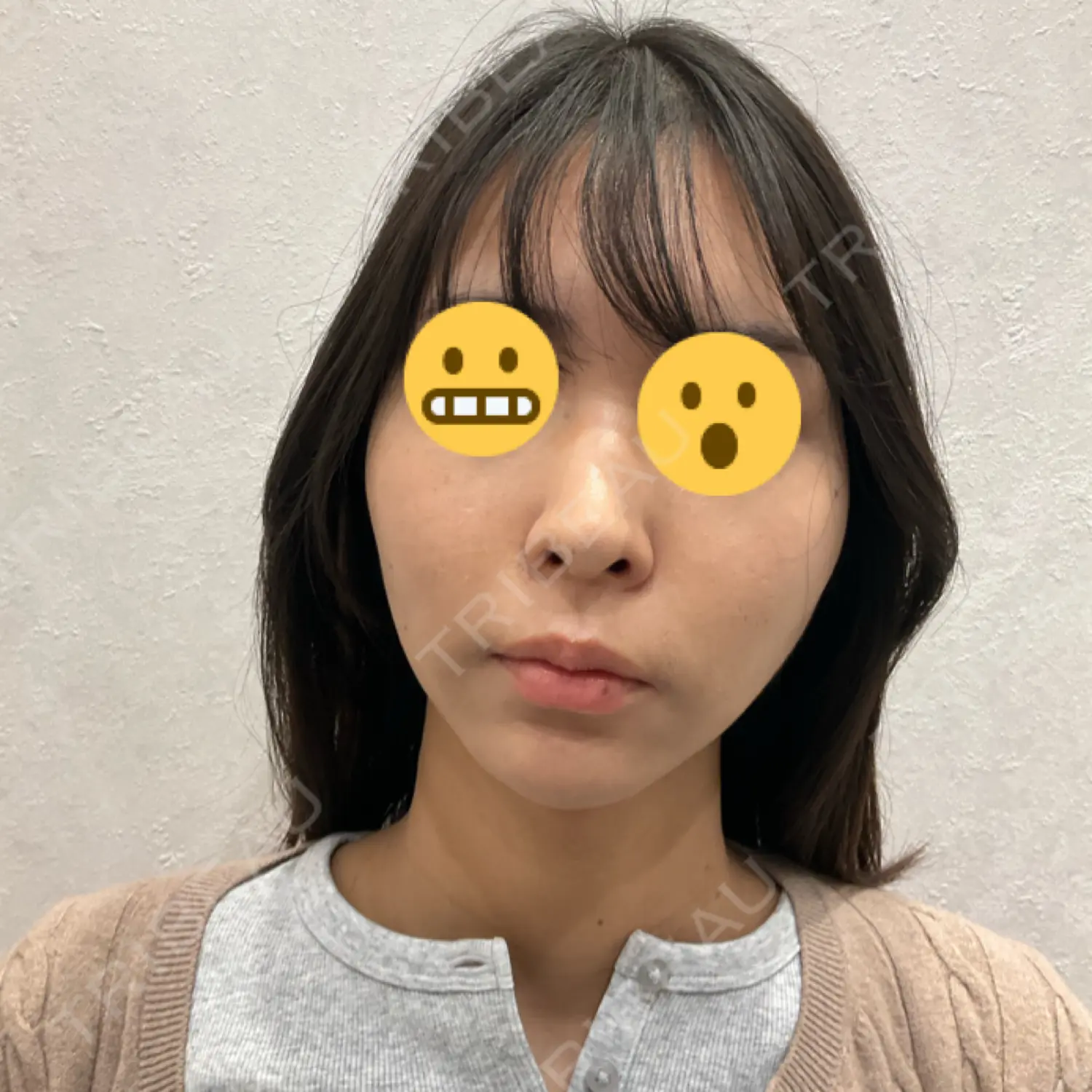 施術後の写真