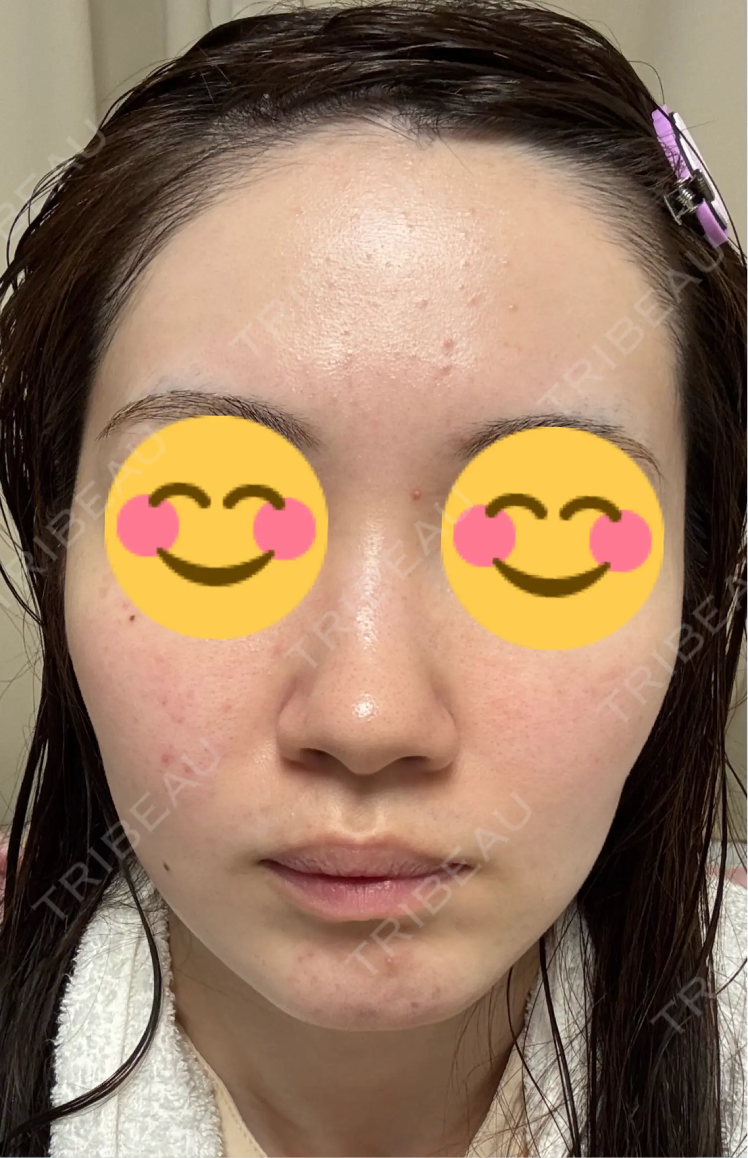 施術後の写真