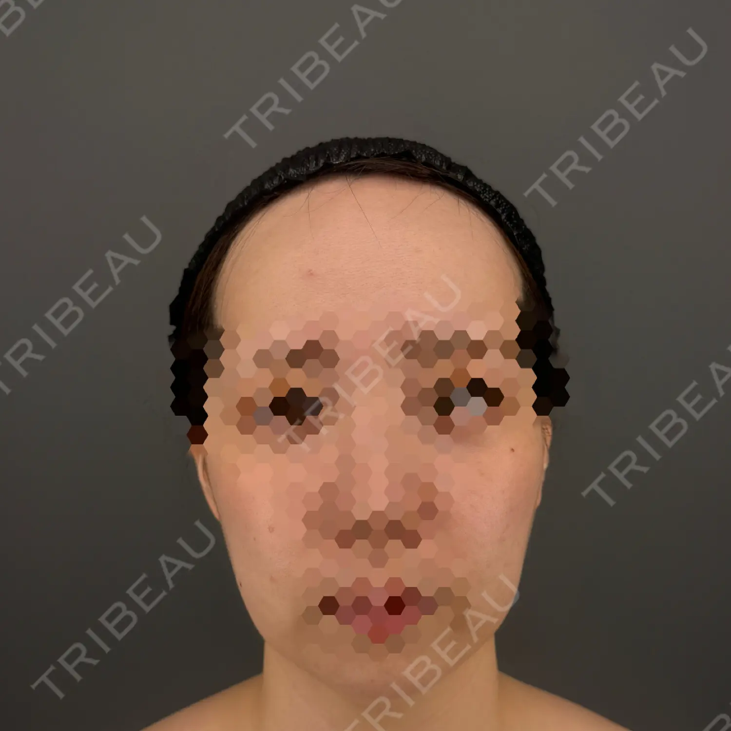 施術後の写真