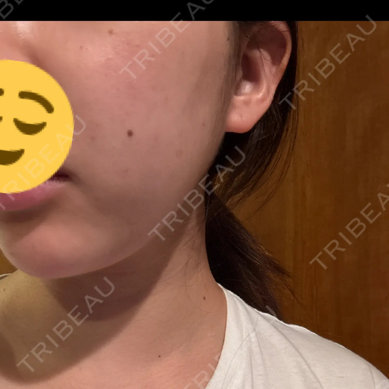施術後の写真