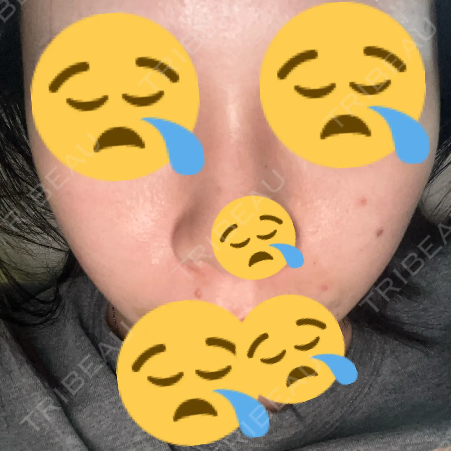 施術後の写真