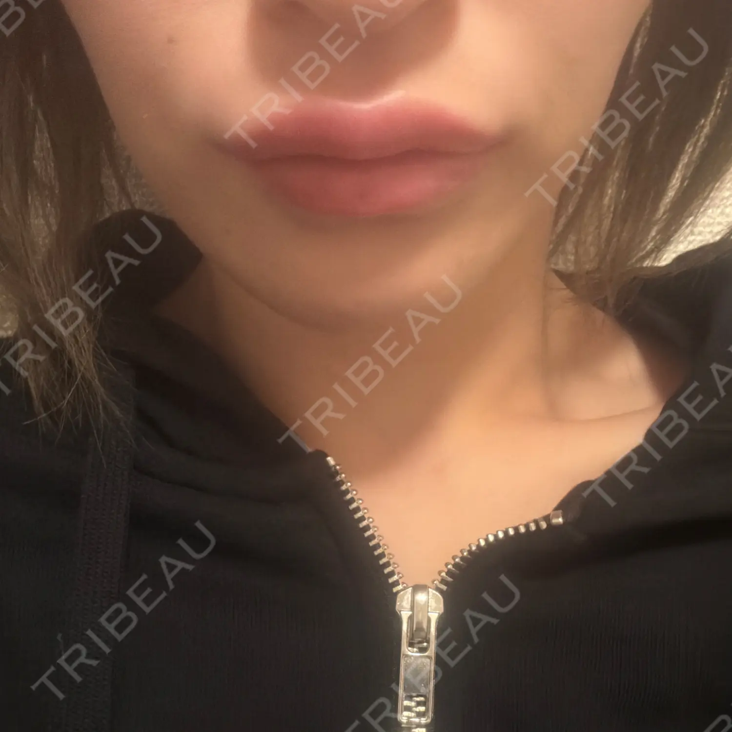 施術後の写真