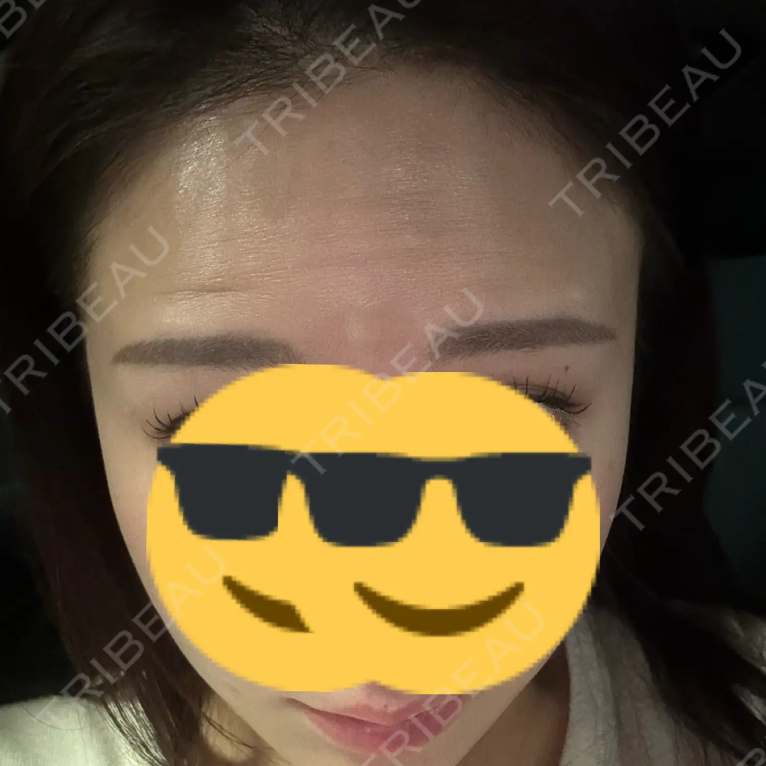 施術後の写真