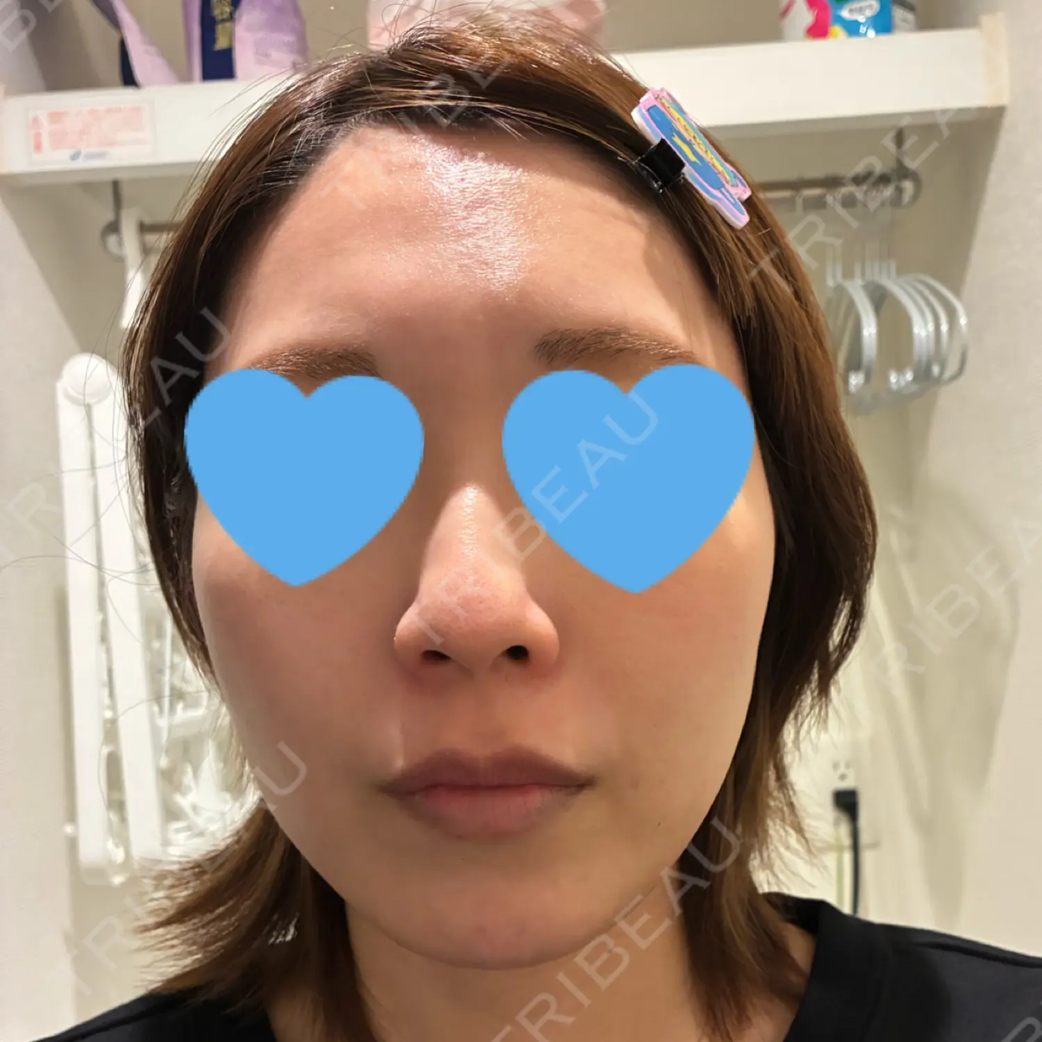 施術後の写真