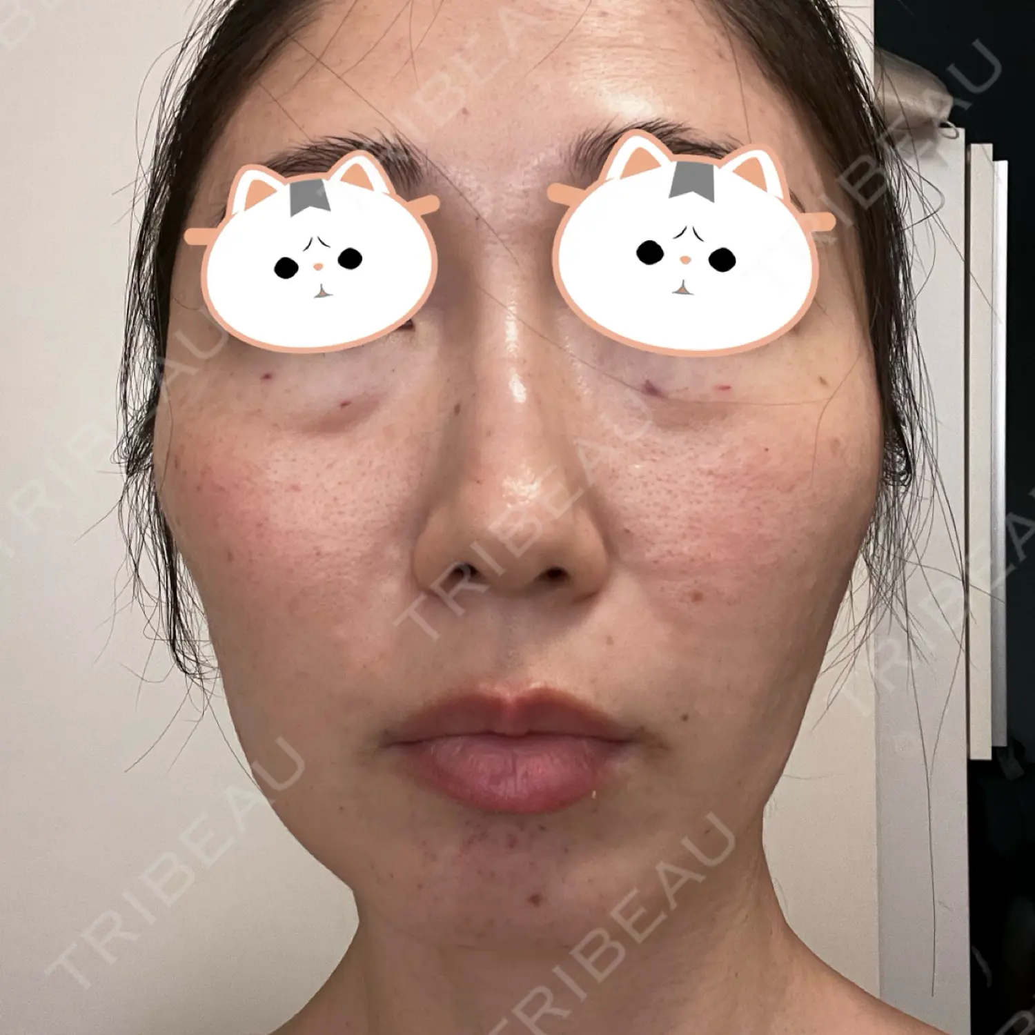 施術後の写真