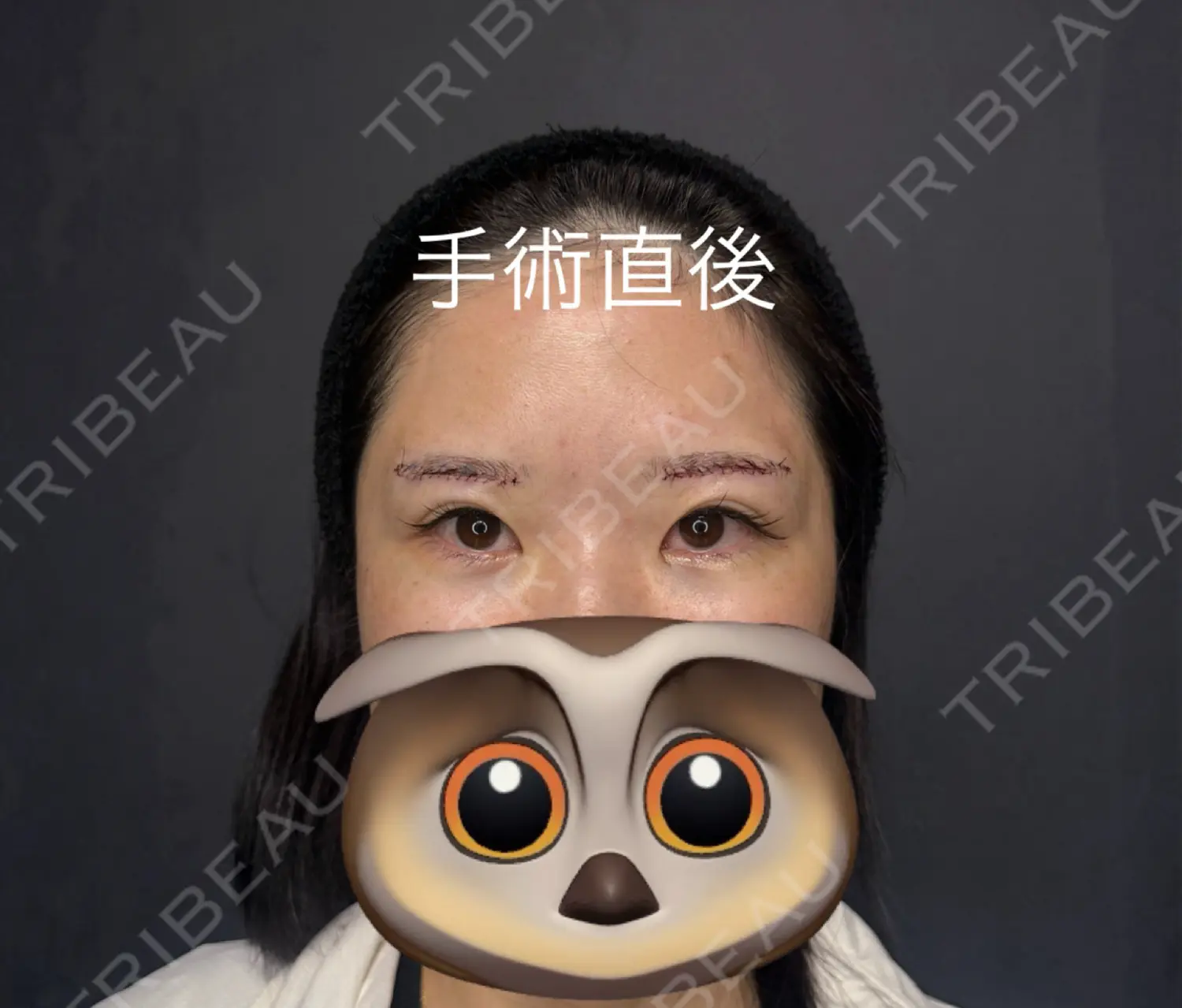 施術後の写真