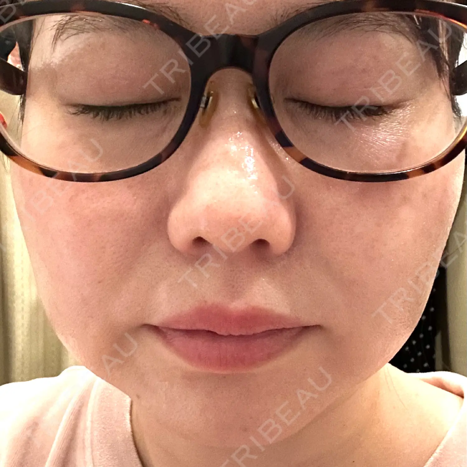 施術後の写真