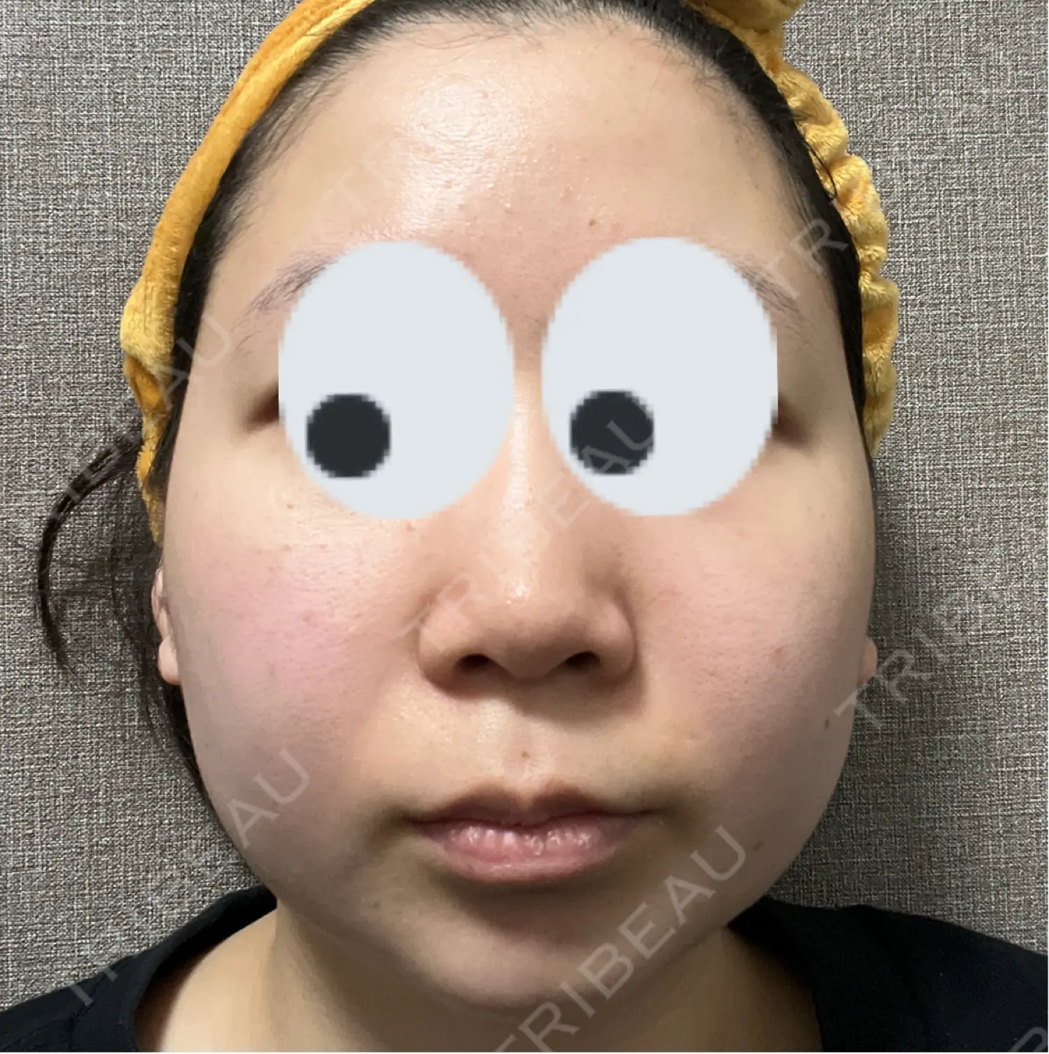 施術後の写真