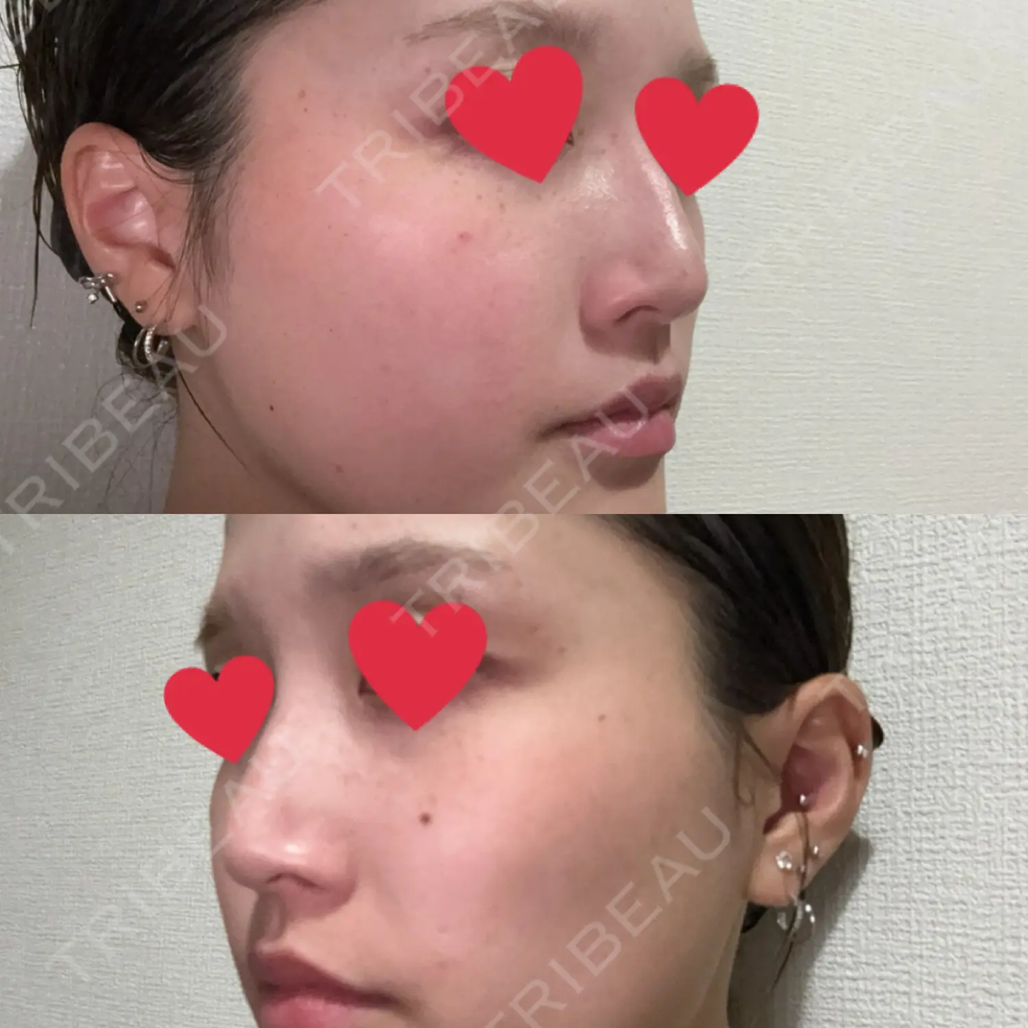 施術後の写真
