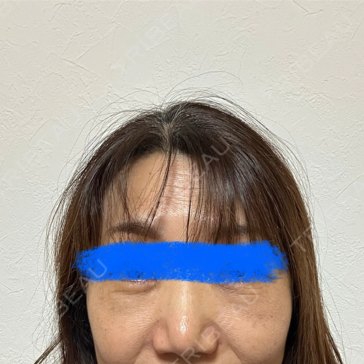 施術後の写真