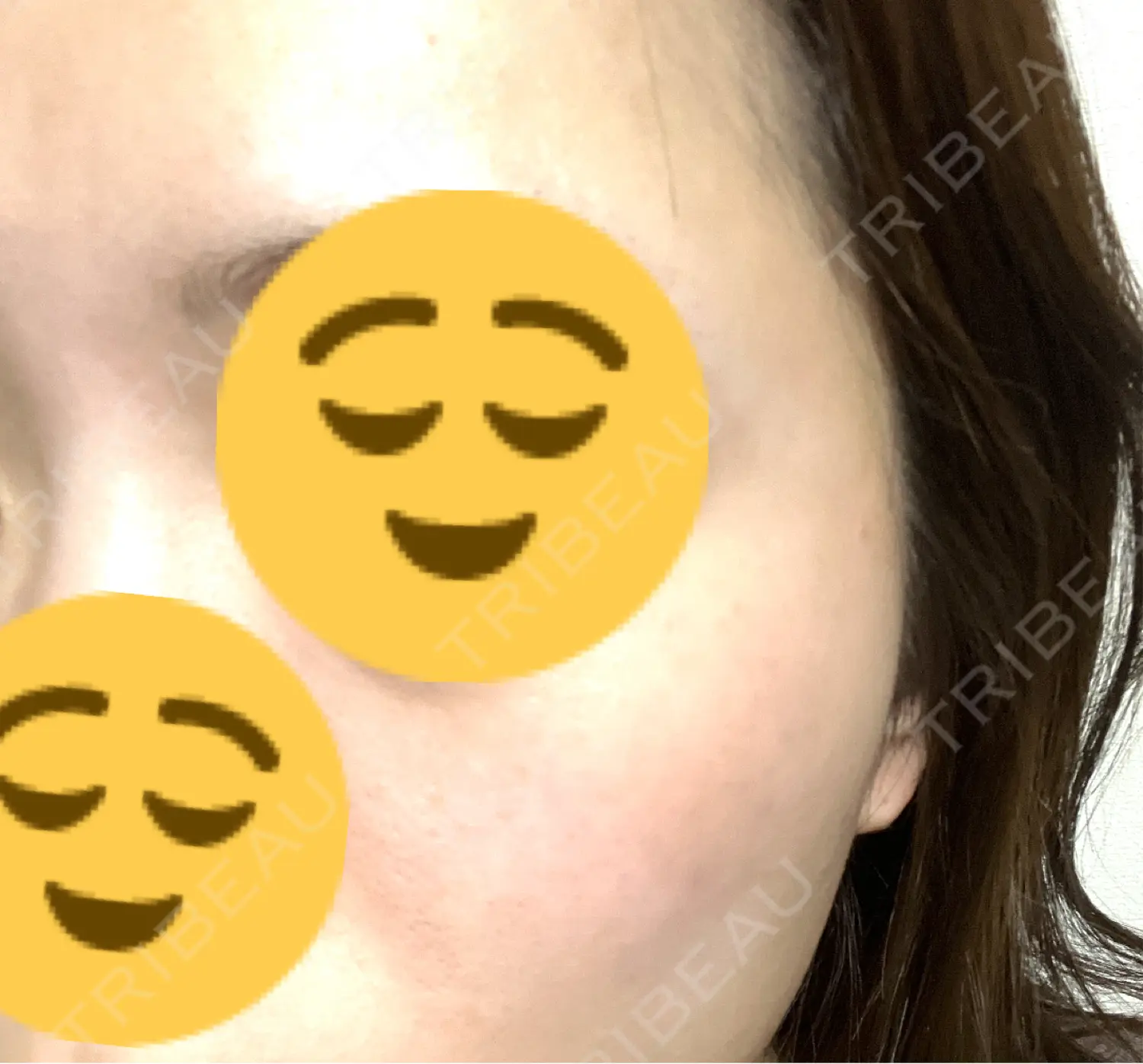 施術後の写真
