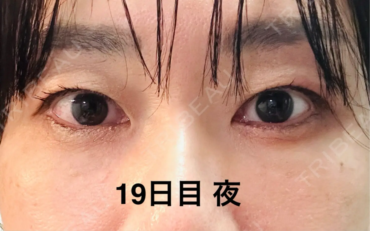 施術後の写真