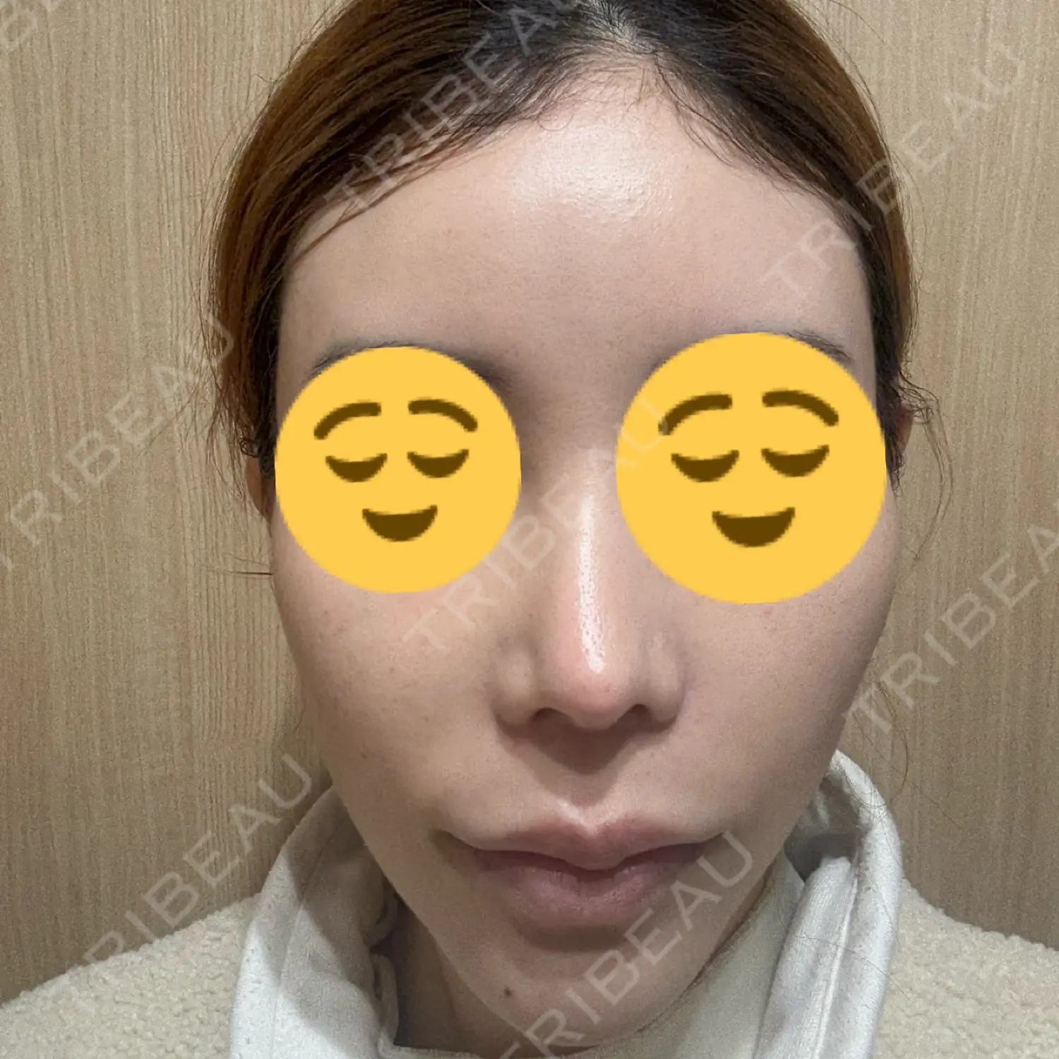 施術後の写真